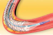 Biosensors Intenrational BioMatrix NeoFlex